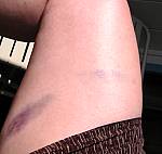 Bruise