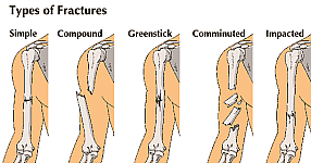 Fractures
