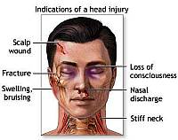 Head injury